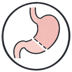 Icon Gastrectomy